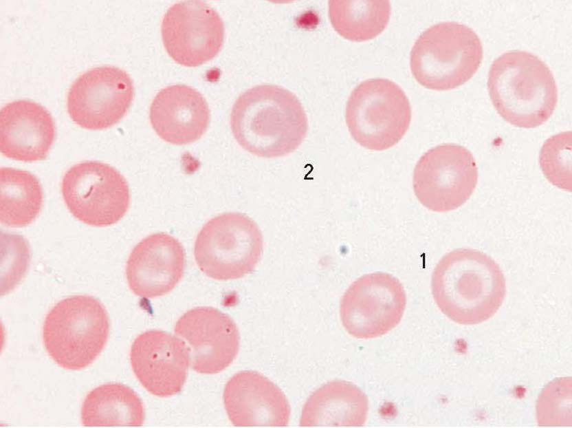靶形红细胞
